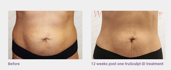 truSculpt-Body-Contouring-Chicago-before-and-after