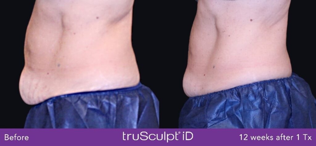 trusculpt-chicago-before-and-after